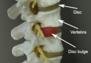 Treatment For Disc Prolapse Or Pivd Reliva Physiotherapy