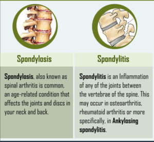 Spondylosis-Spondylitis – ReLiva Physiotherapy & Rehab