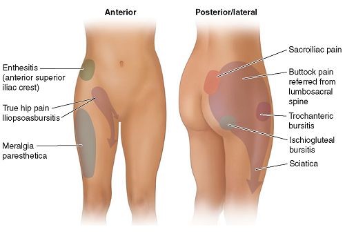 Hip Pain Treatment Reliva Physiotherapy Rehab