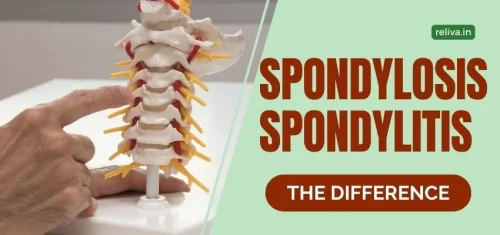 Understanding Spondylosis Spondylitis