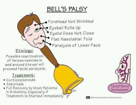 https://reliva.in/wp-content/uploads/2018/05/bells-palsy-flash-card-1.jpg