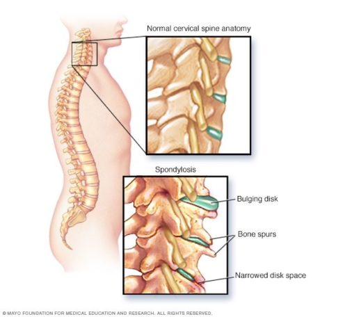 Cervical spondylosis spine