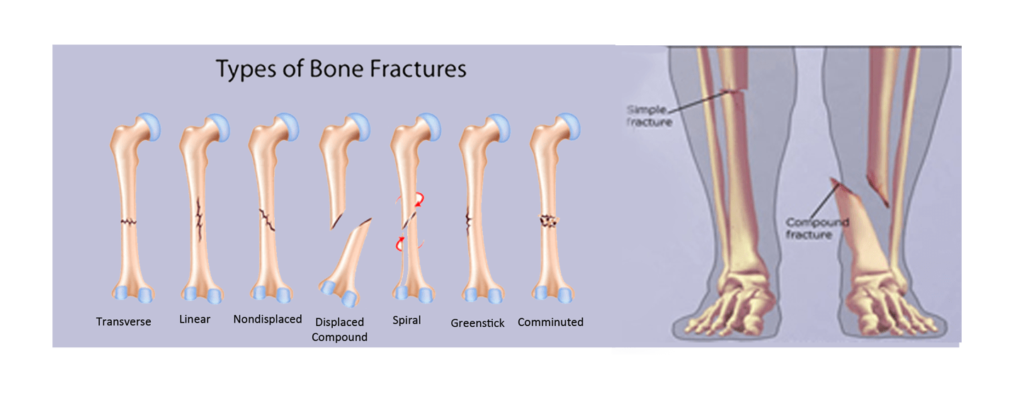 5 Different Types Of Fractures