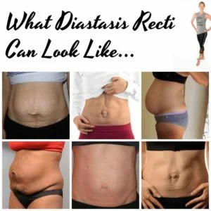 Bulging belly due to diastasis Recti