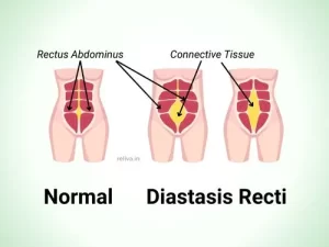 15 Diastasis recti ideas  diastasis recti, diastasis, post partum workout