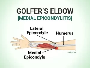 Golfer’s Elbow Medial Epicondylitis