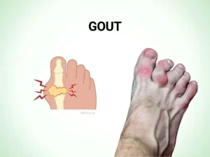 Gout