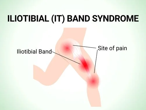 Iliotibial Band syndrome