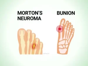 Mortons Neuroma Bunion