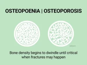 Osteoporosis Osteopoenia