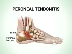 Peroneal Tendonitis