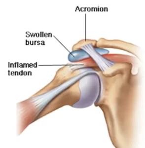 Rotator Cuff Tendinitis
