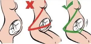 Seat belt in pregnancy