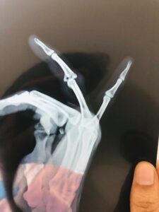 X ray image of ring finger fracture treatment tele physiotherapy