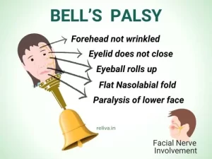 bell's palsy symptoms