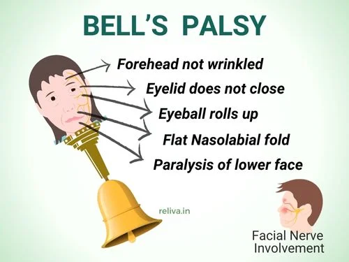 bells palsy symptoms