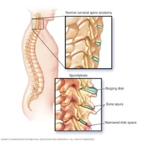 cervical spondylosis spine
