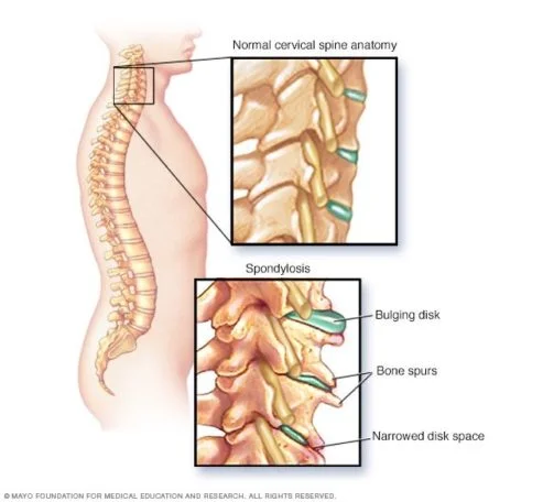cervical spondylosis spine