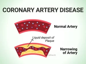 coronary artery disease