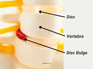 spine and disc bulge