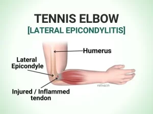 Tennis elbow lateral epicondylitis