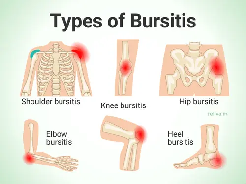Types of Bursitis