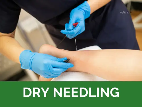 dry Needling