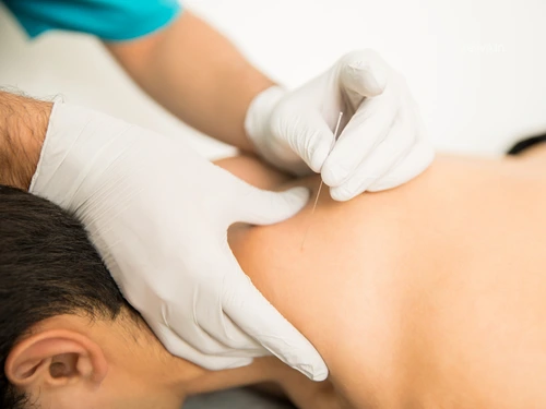 needling for shoulder and neck