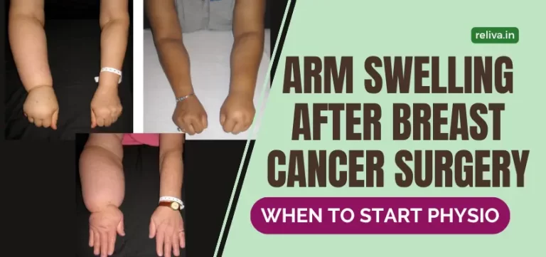 Arm Swelling After Breast Cancer Surgery when to start physiotherapy