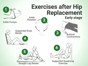 Physiotherapy Exercises after Hip Replacement