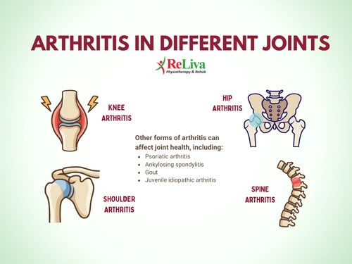 Arthritis in Different Joints