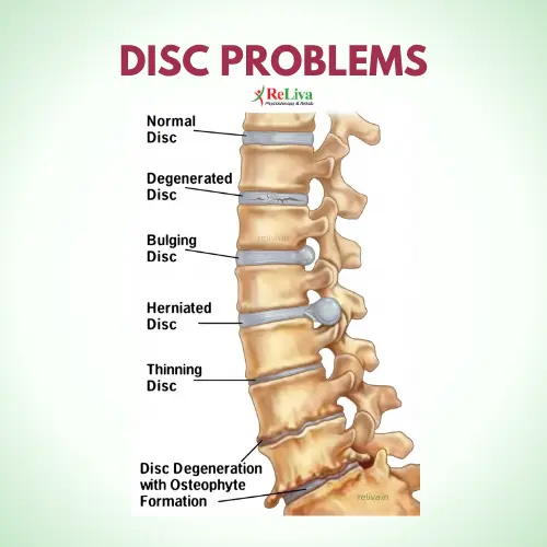 Disc problems vs Normal Spine