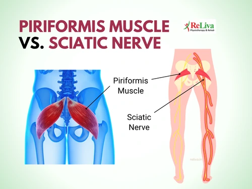 Piriformis Muscle vs. Sciatic Nerve