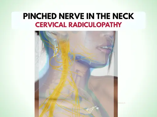Pinched Nerve in the NECK image